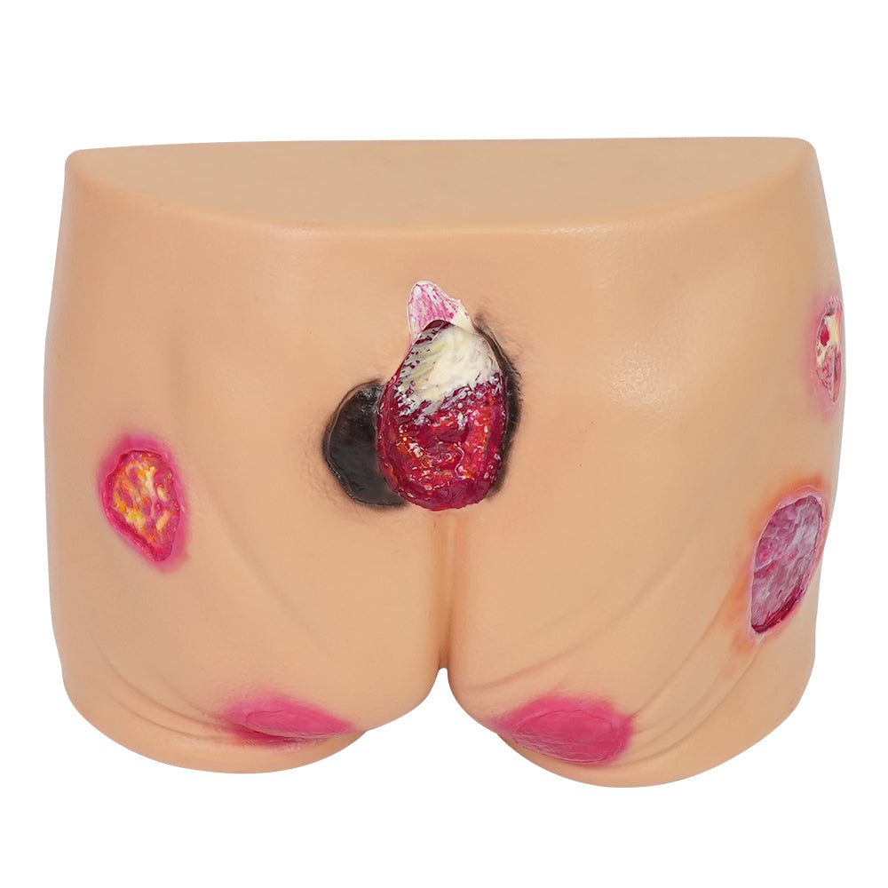 Five Stages Pressure Ulcer Simulation On Buttock