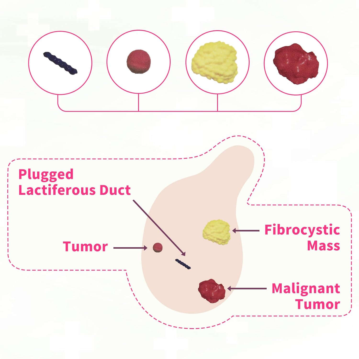 Four Detectable Lump Types on BSE Model