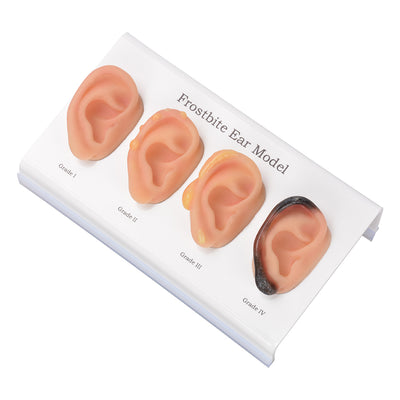 Four Frostbite Ear Models Mounted On Acrylic Stand