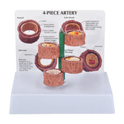 Four Stage Atherosclerosis Progression Model