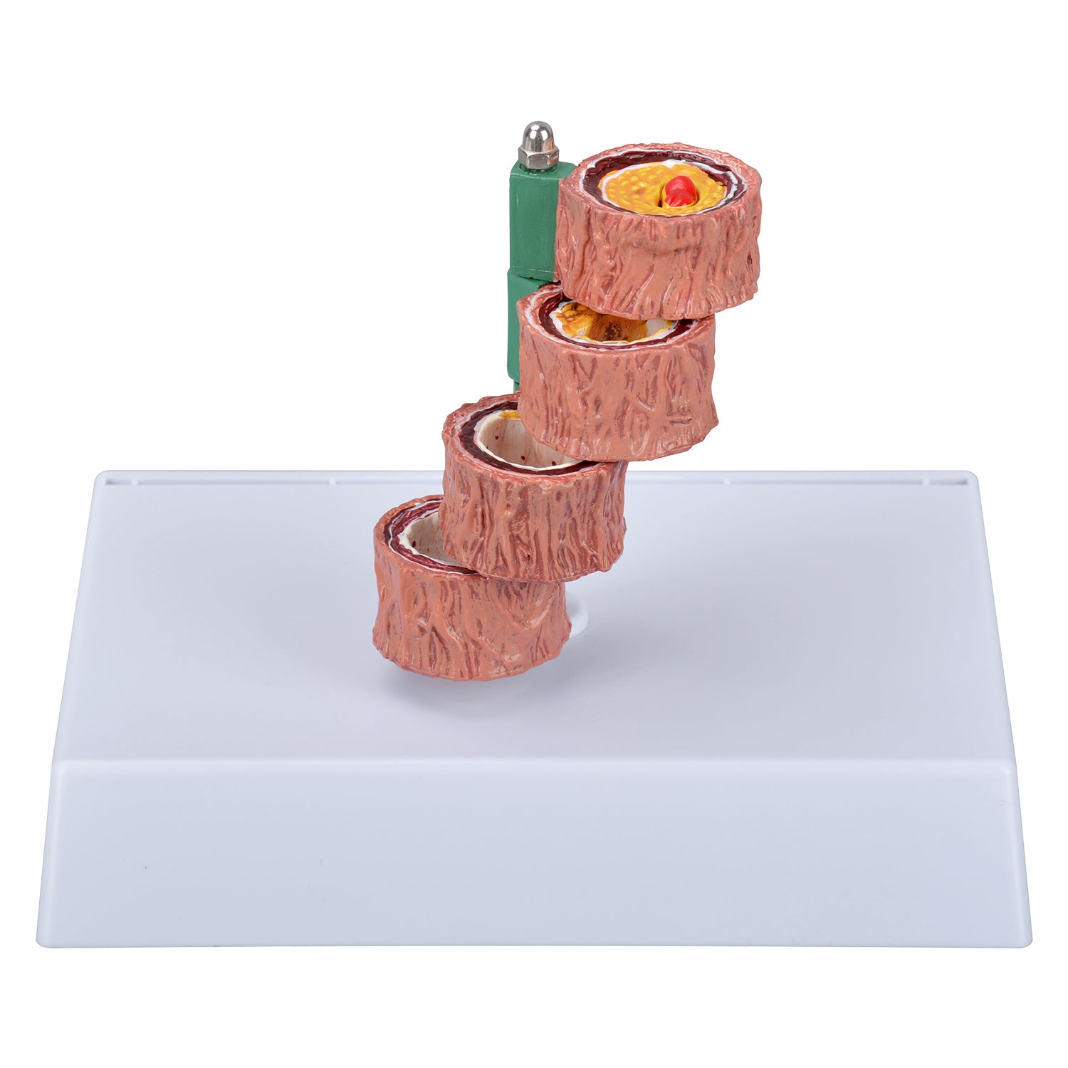 Four Stage Atherosclerosis Progression Model