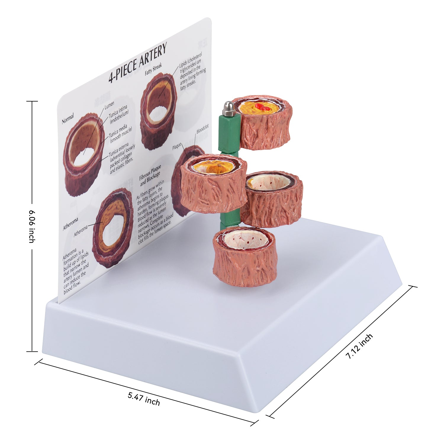 Four Stage Atherosclerosis Progression Model