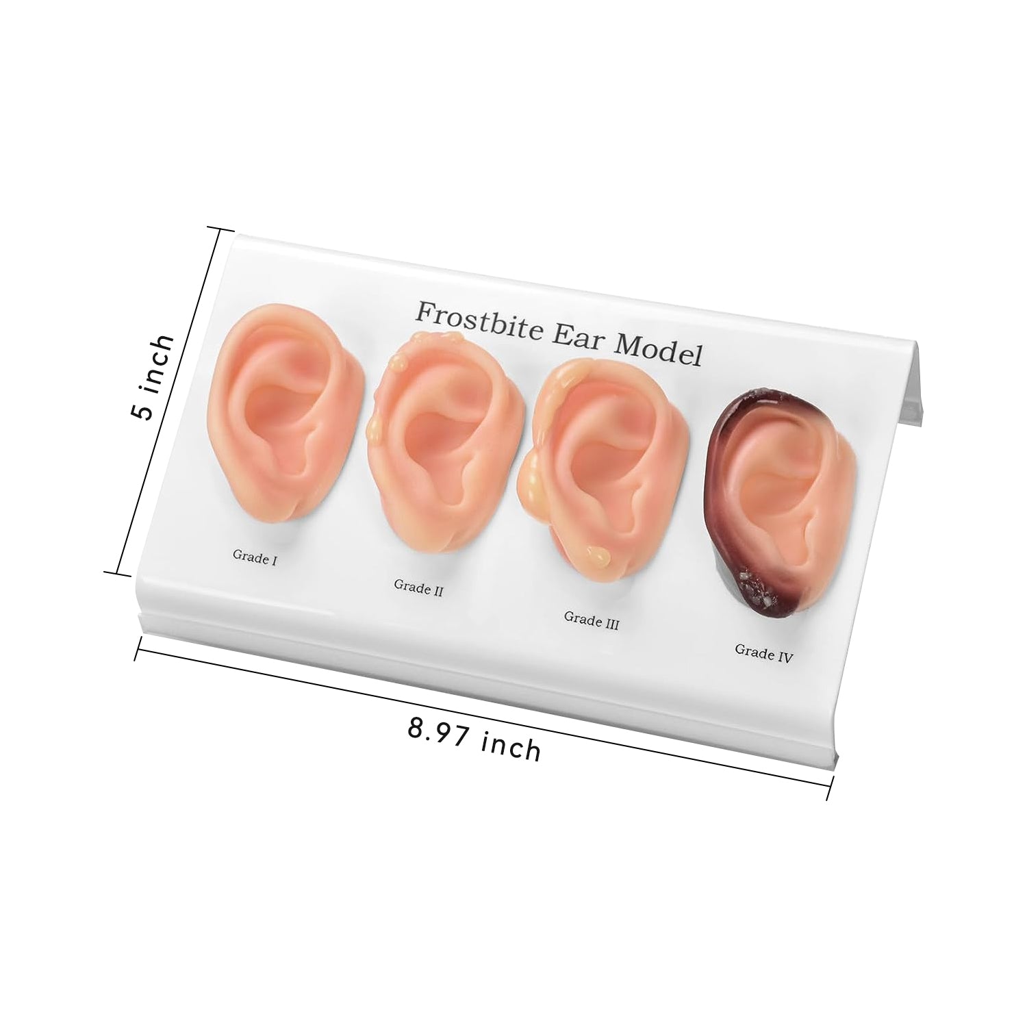 Frostbite Ear Teaching Model with Grade 1-4 Stages