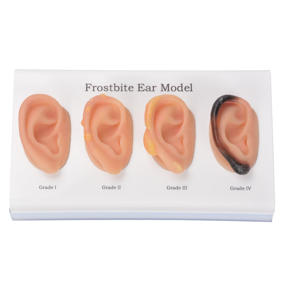 Frostbite Ear Training Model Showing All Four Stages