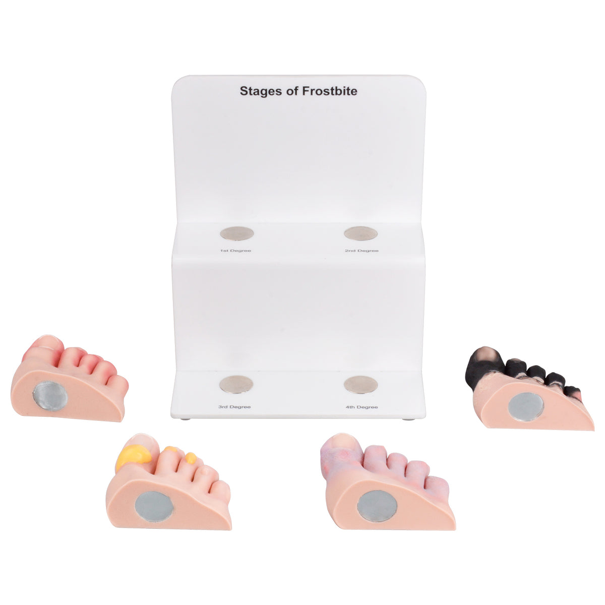 Frostbite Model Tools Foot Toe Frostbite Model for Medical Training, Teaching, Patient ...