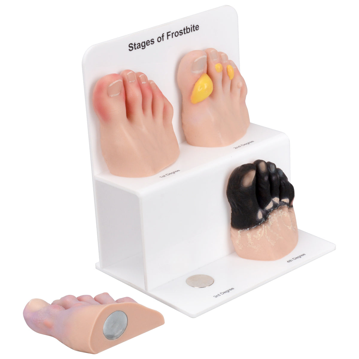 Grade Toe Foot Toe Frostbite Model for Medical Training, Teaching, Patient ...