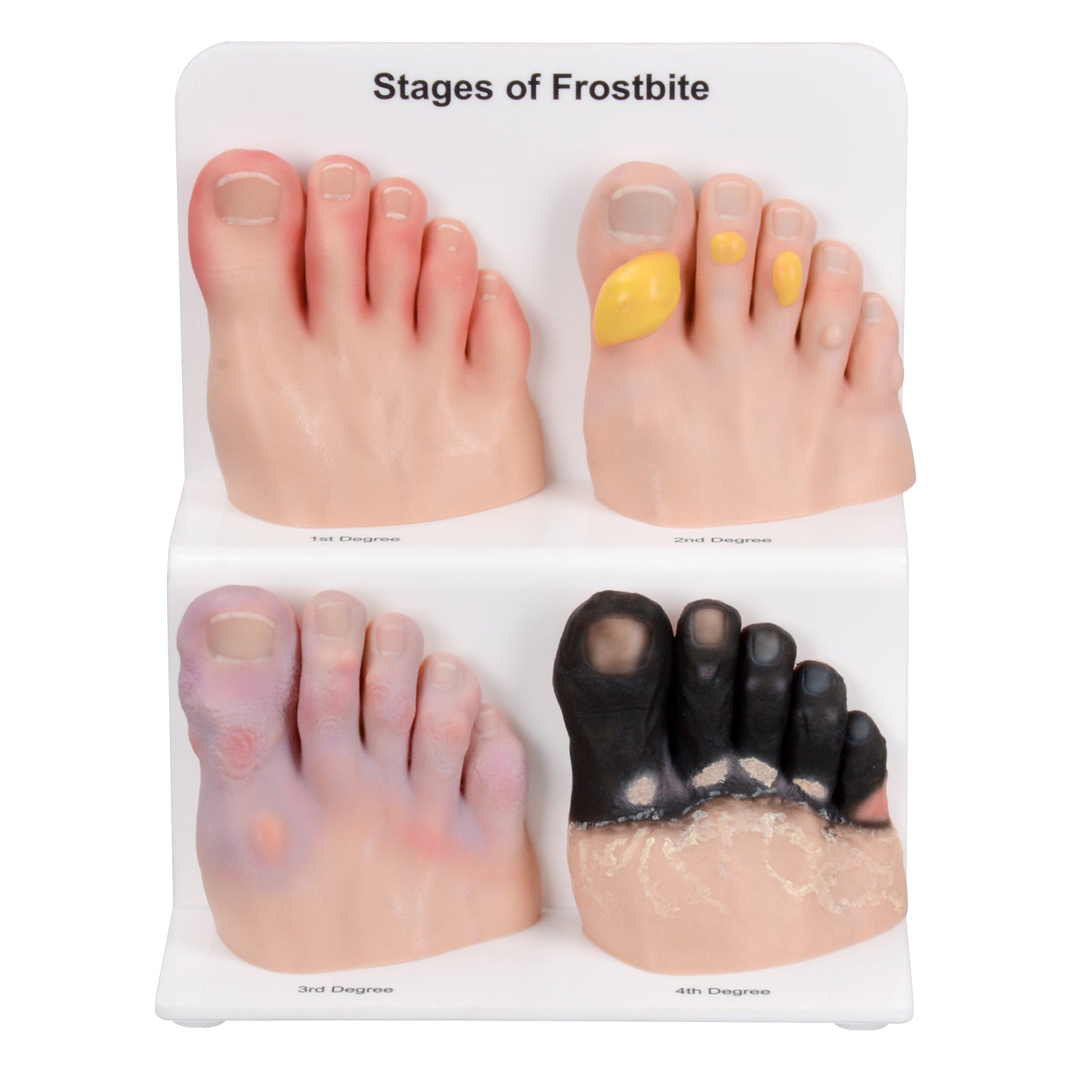 Grade 1-4 Foot Toe Frostbite Display & Teaching Model