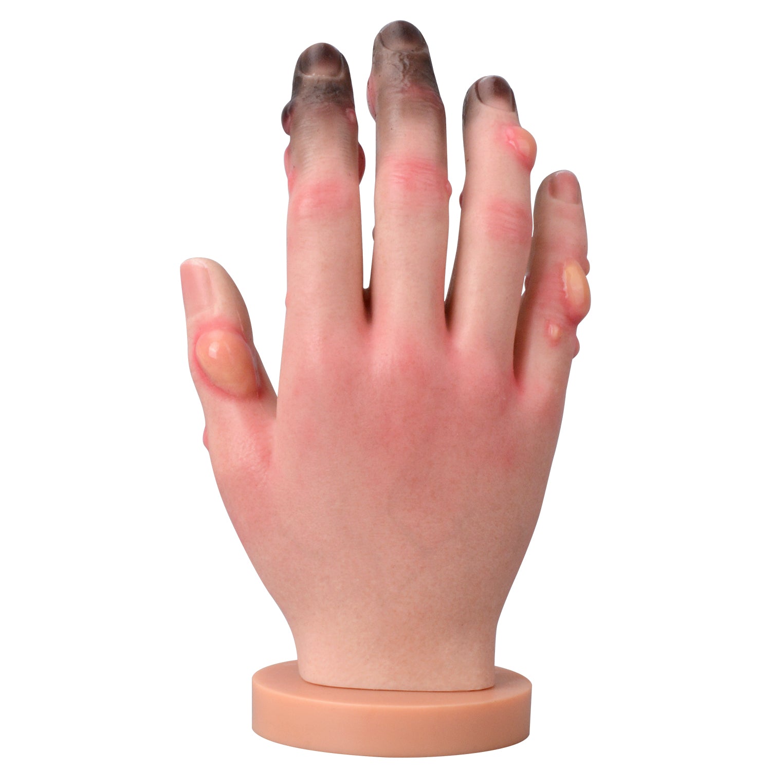 Grade 1-4 Hand Frostbite Training Model