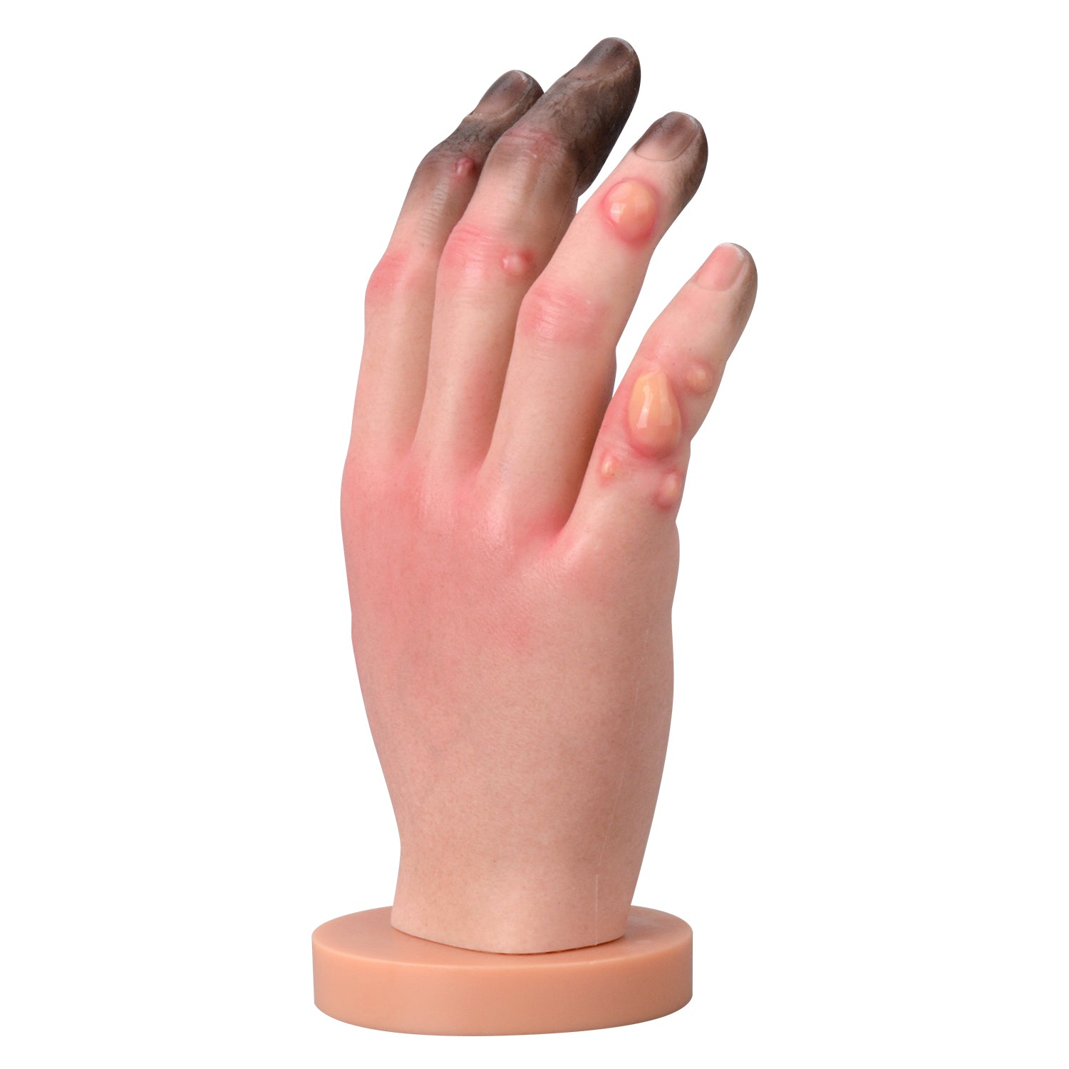 Grade 1-4 Hand Frostbite Training Model