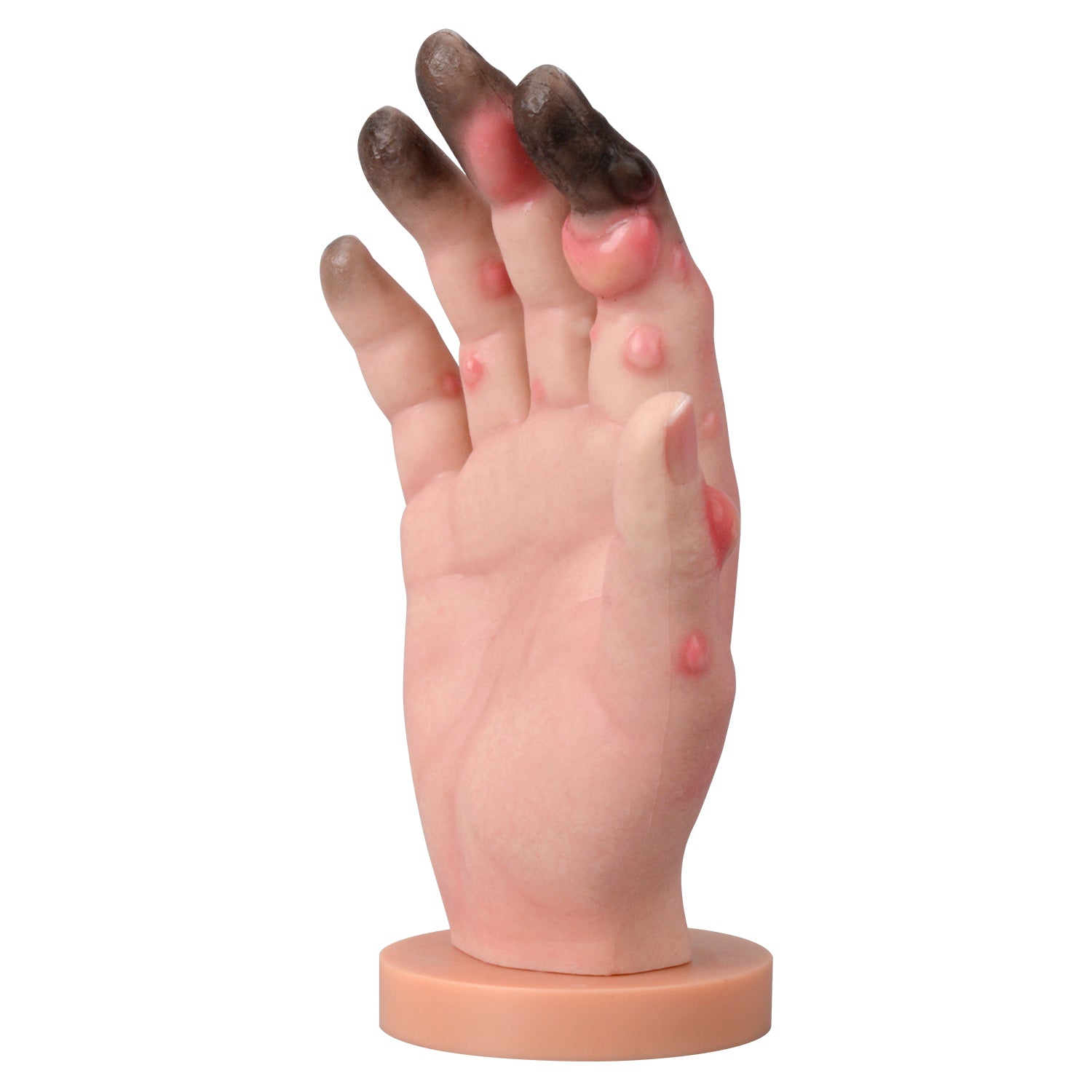 Grade 1-4 Hand Frostbite Training Model