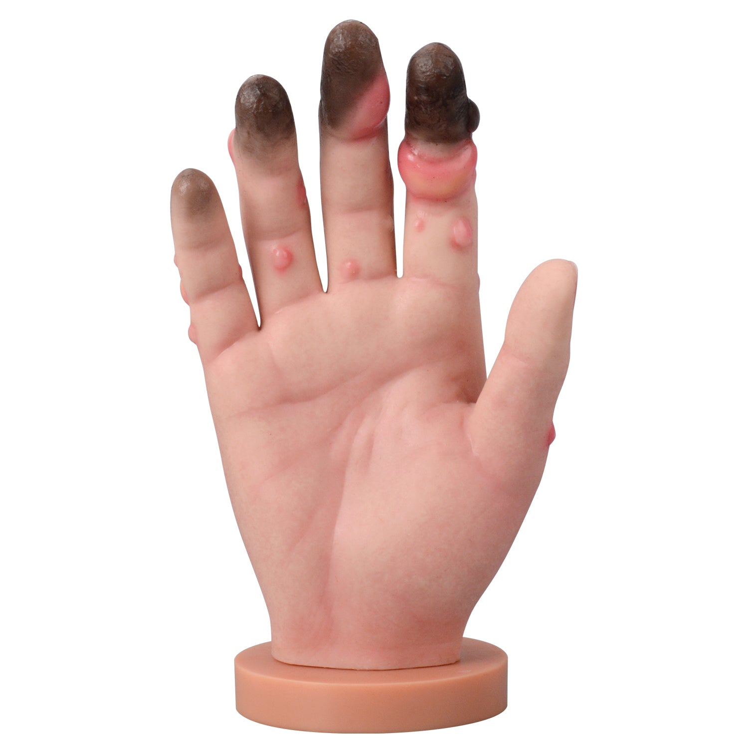 Grade 1-4 Hand Frostbite Training Model