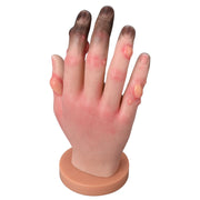 Grade 1-4 Hand Frostbite Training Model