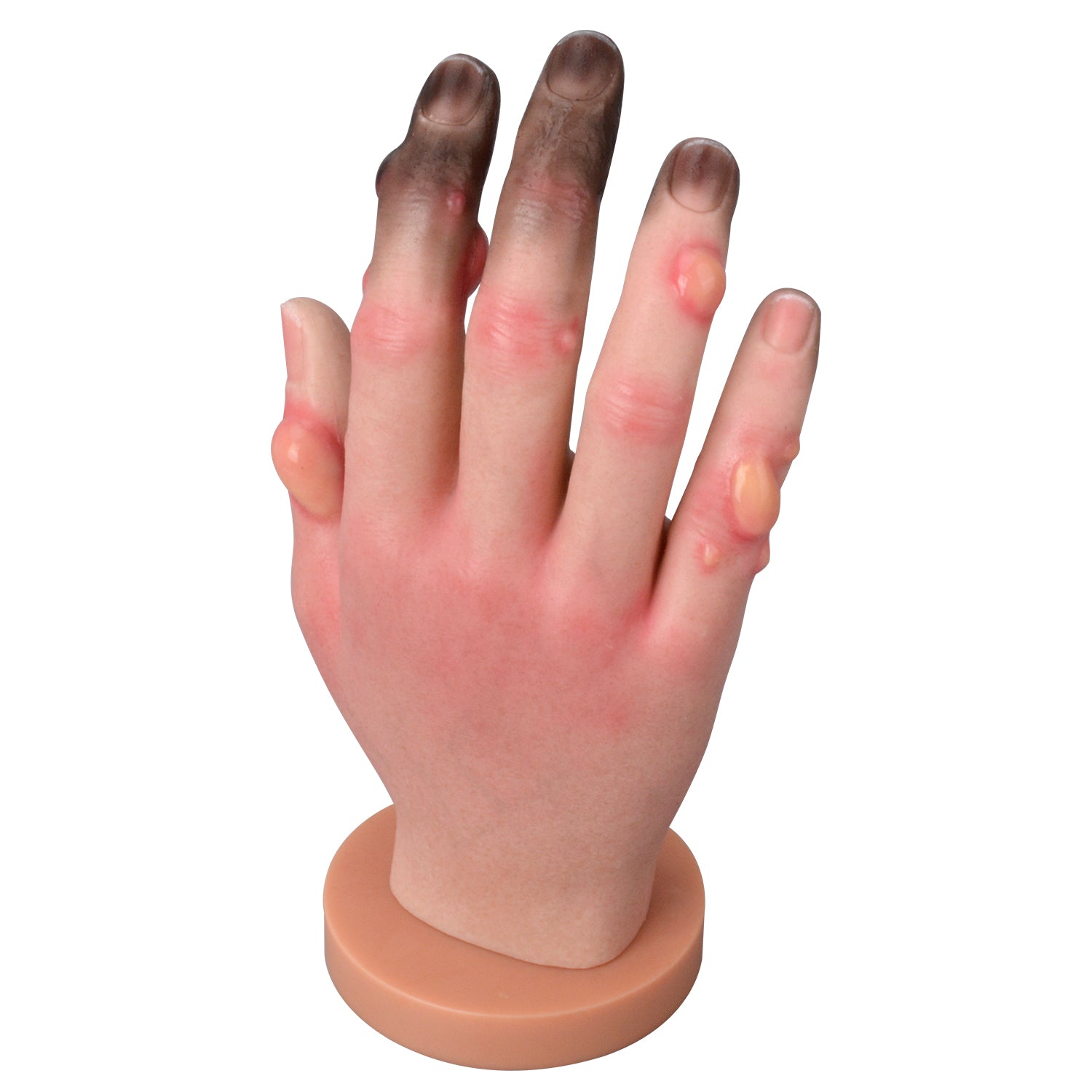 Grade 1-4 Hand Frostbite Training Model