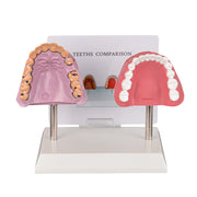 Healthy Vs Smoker Mouth Model For Oral Health Education