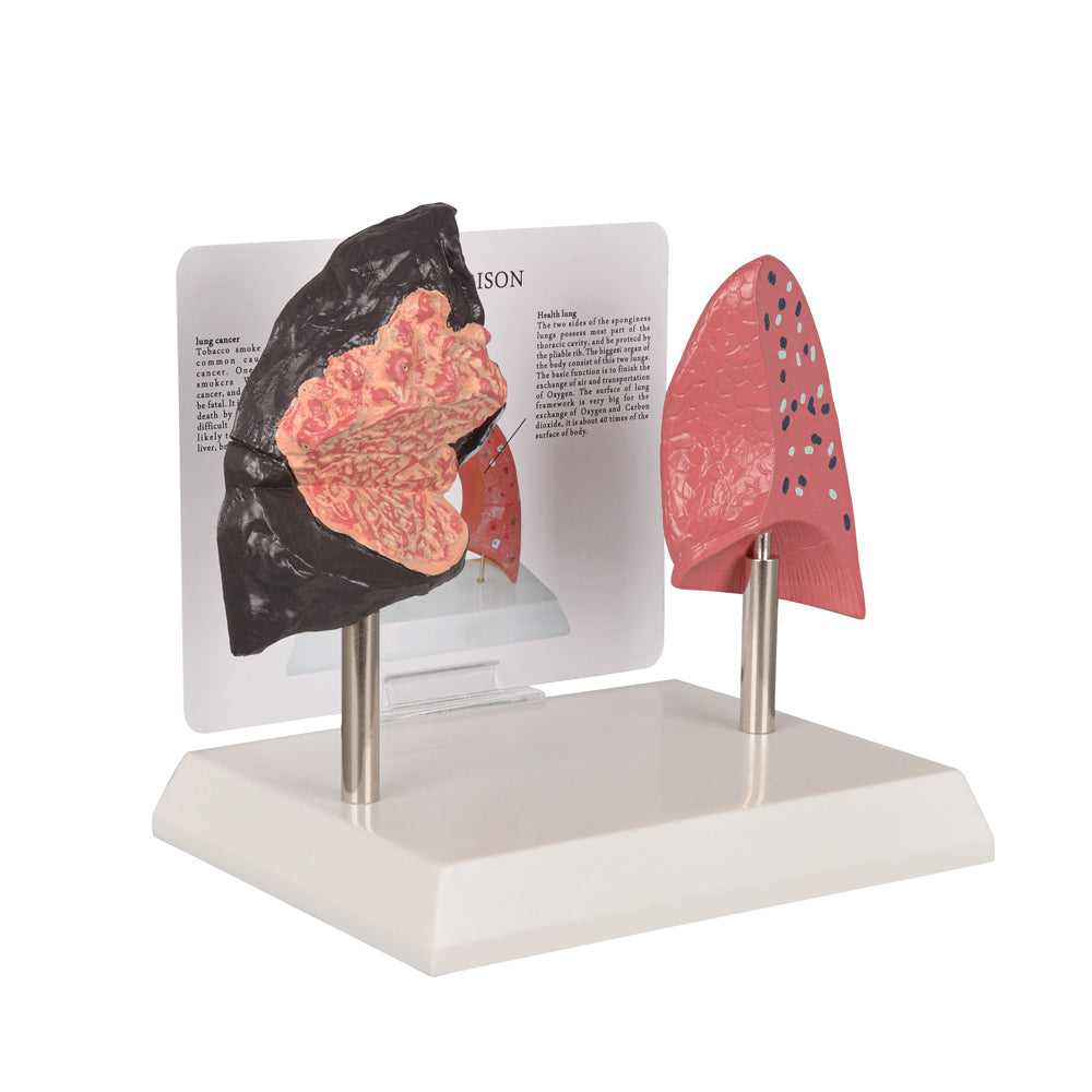 Healthy vs Smoker’s Lung Model