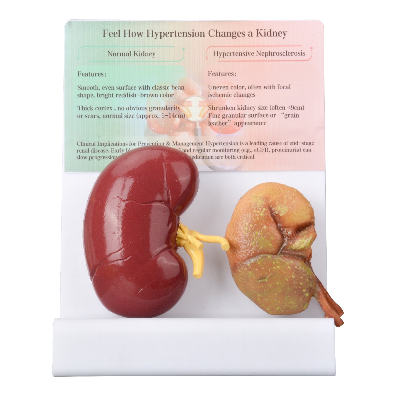 Hypertensive Kidney Model with Normal Kidney Comparison