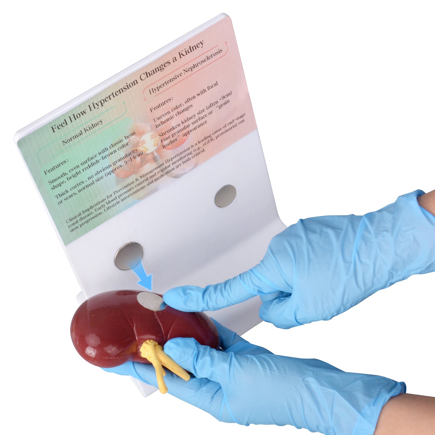 Hypertensive Kidney Model with Normal Kidney Comparison