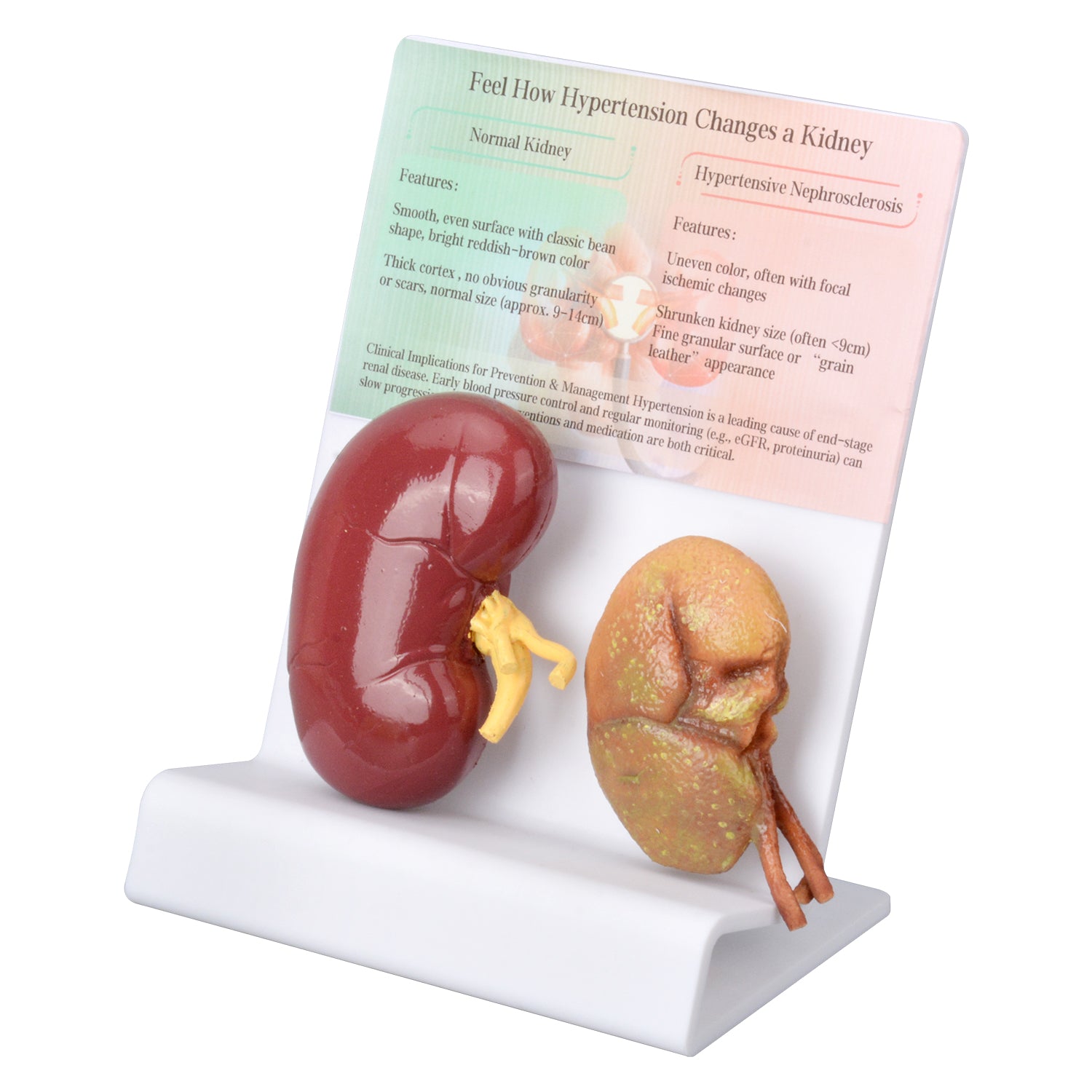 Hypertensive Kidney Model with Normal Kidney Comparison