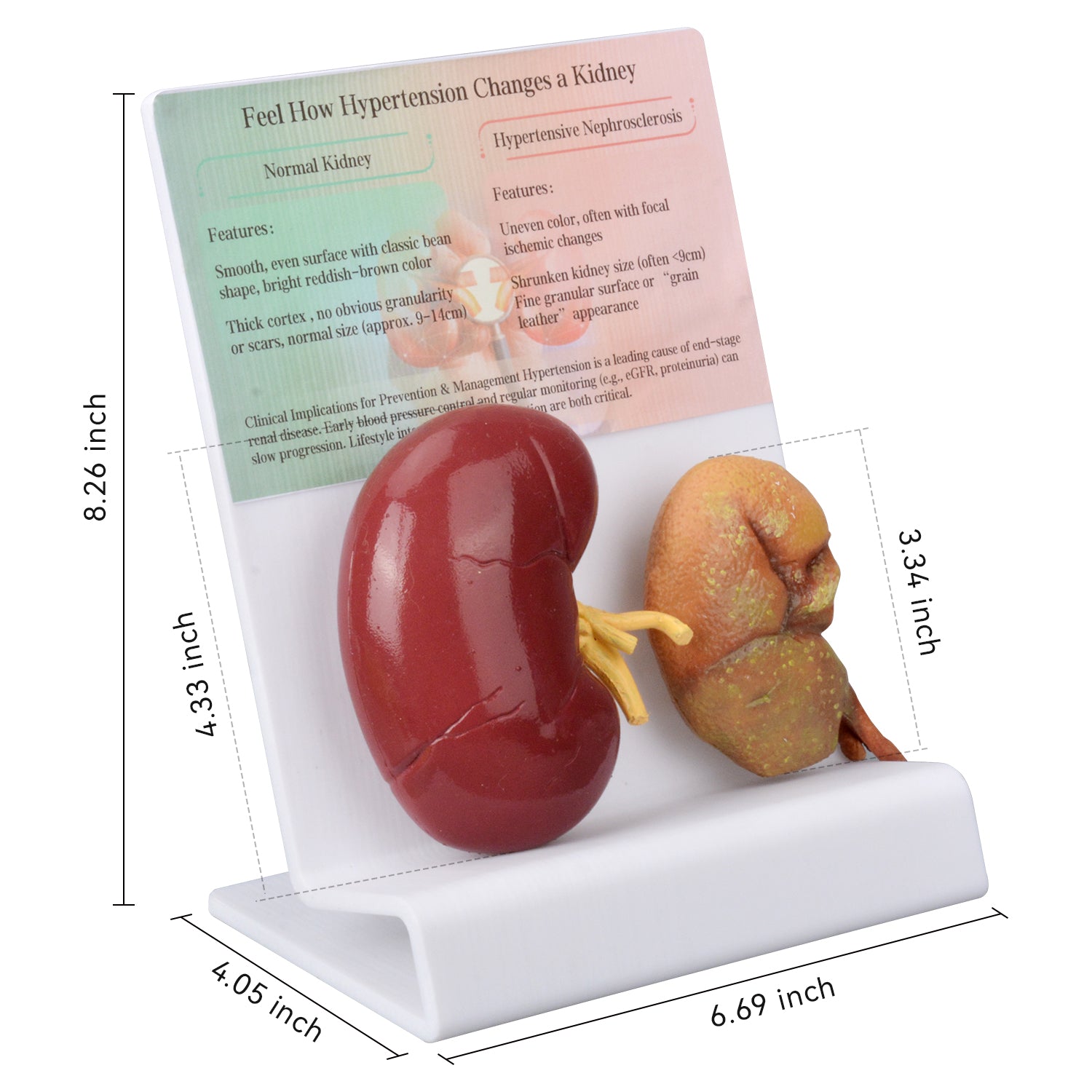 Hypertensive Kidney Model with Normal Kidney Comparison