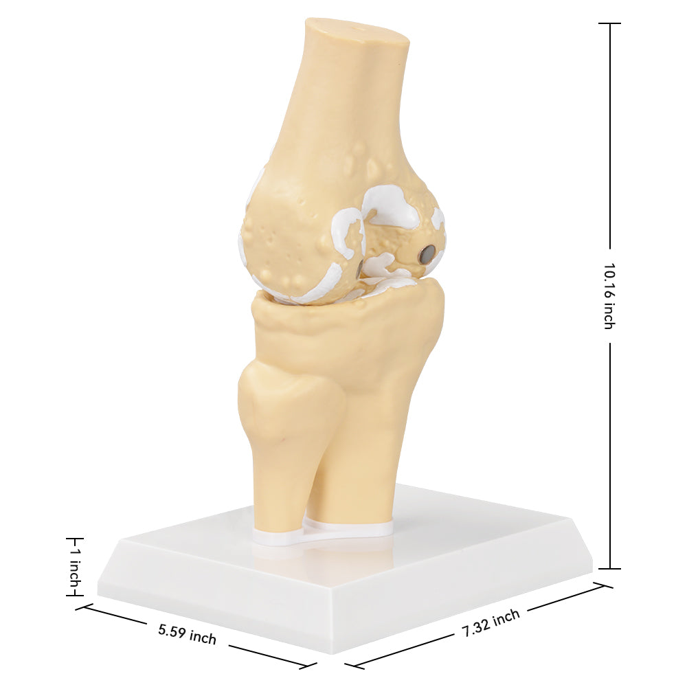 Knee Osteoarthritis Model Size Reference