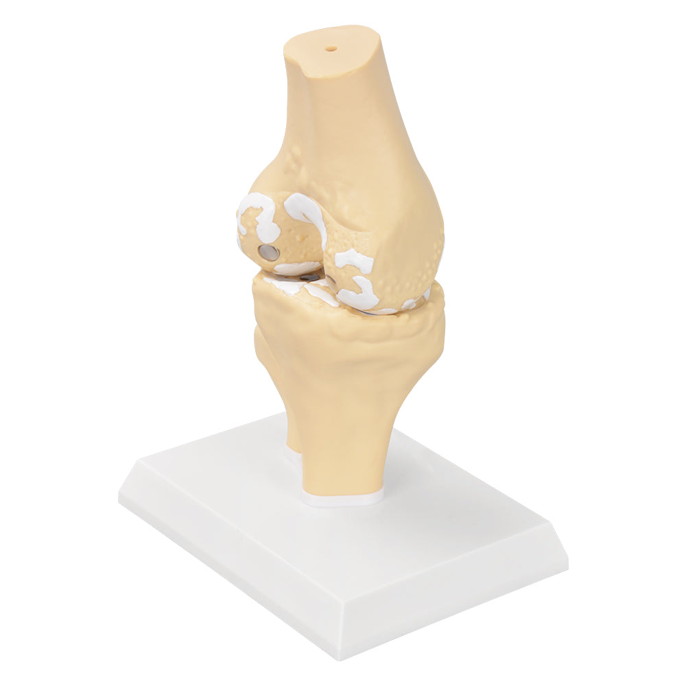 Life Size Osteoarthritis Knee Anatomy Model