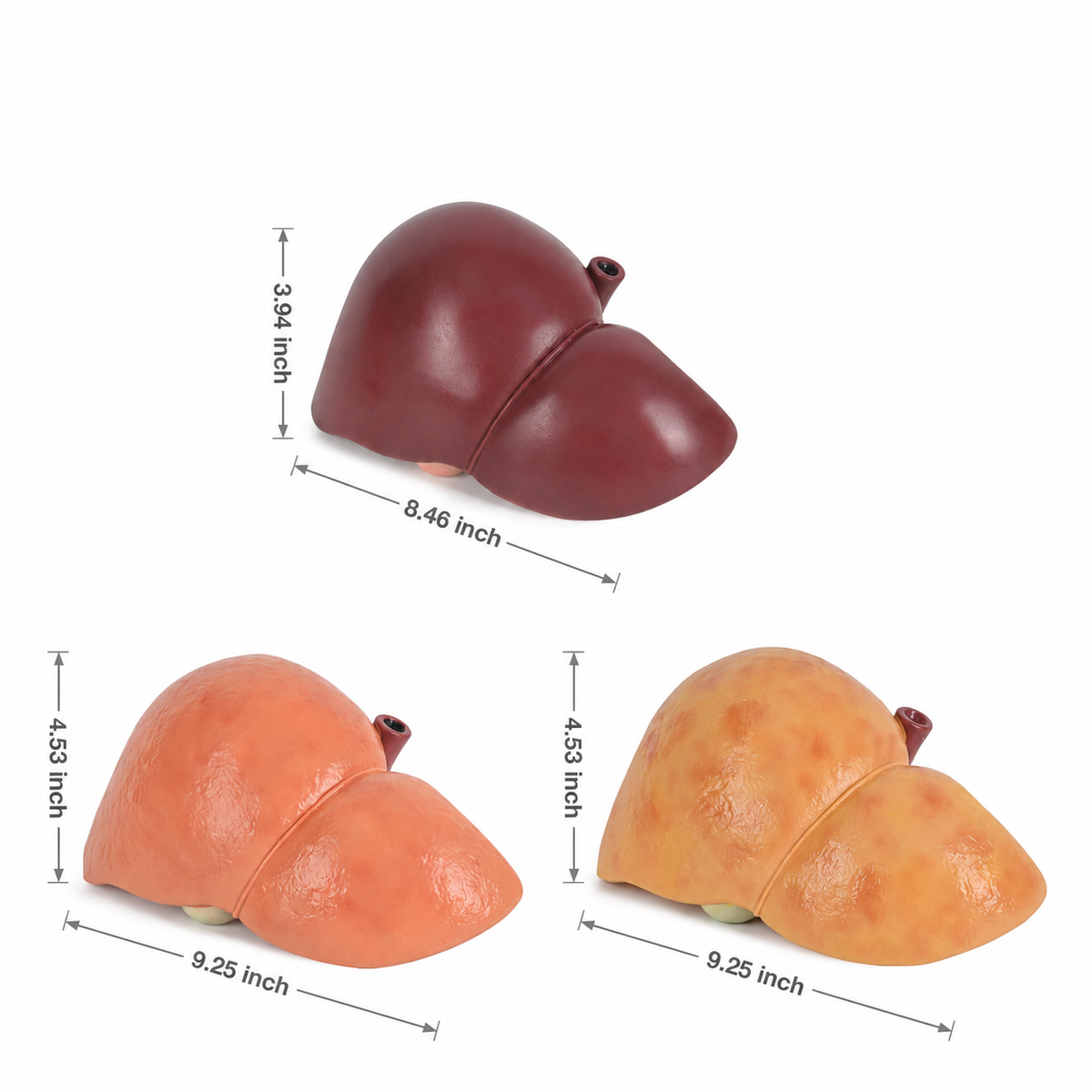 Fatty Liver Model for NAFLD Anatomy & Disease Education