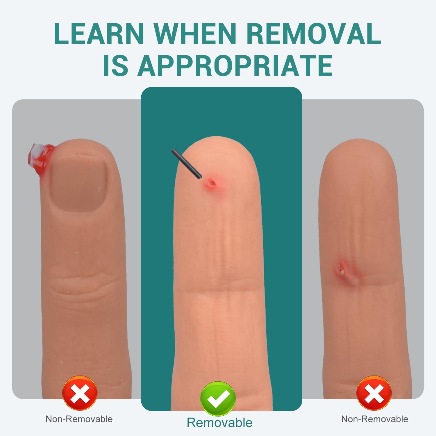 Long Wooden Splinter Injury with Removable Fragment