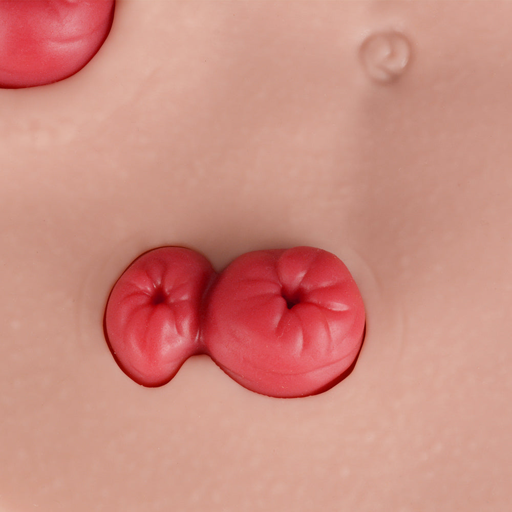 Loop Stoma Model