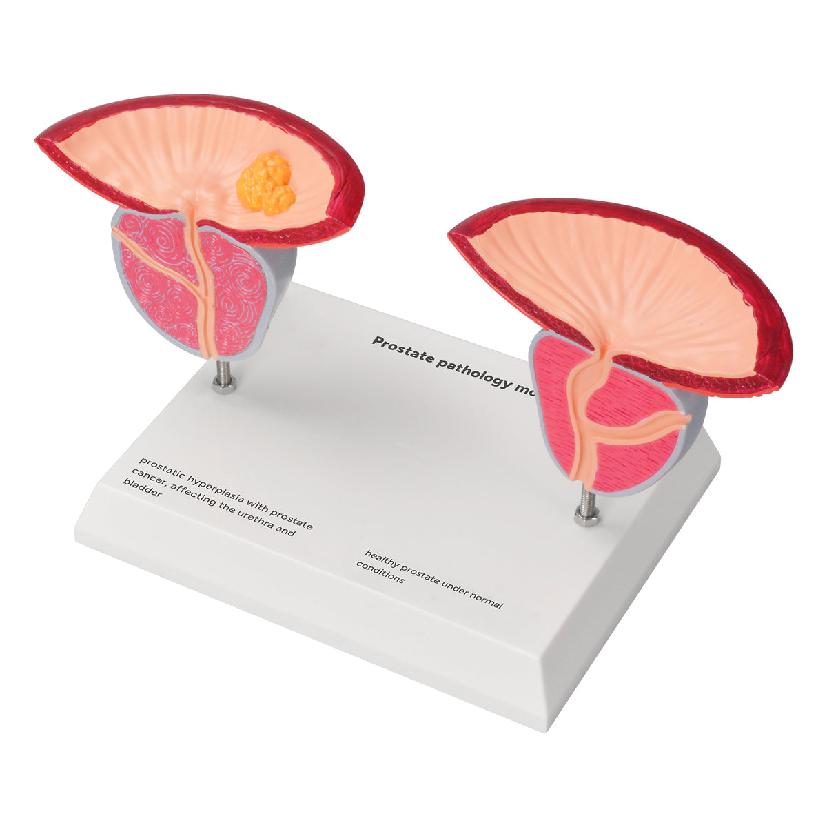 Male Prostate Prostate Anatomy & Pathology Model – Medarchitect