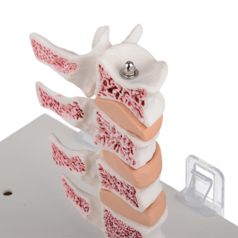 Medical Education Osteoporosis Bone Model