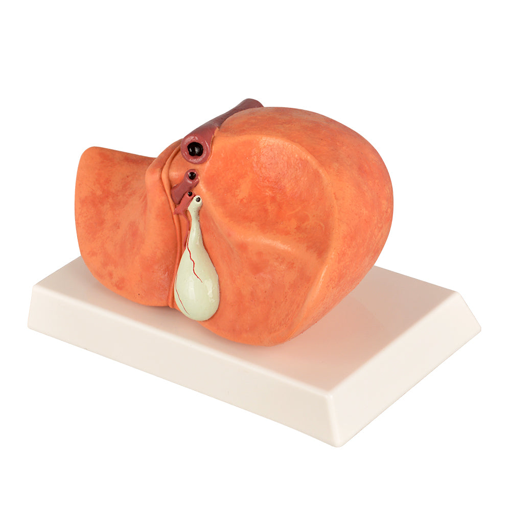 Medical Fatty Liver Educational Model