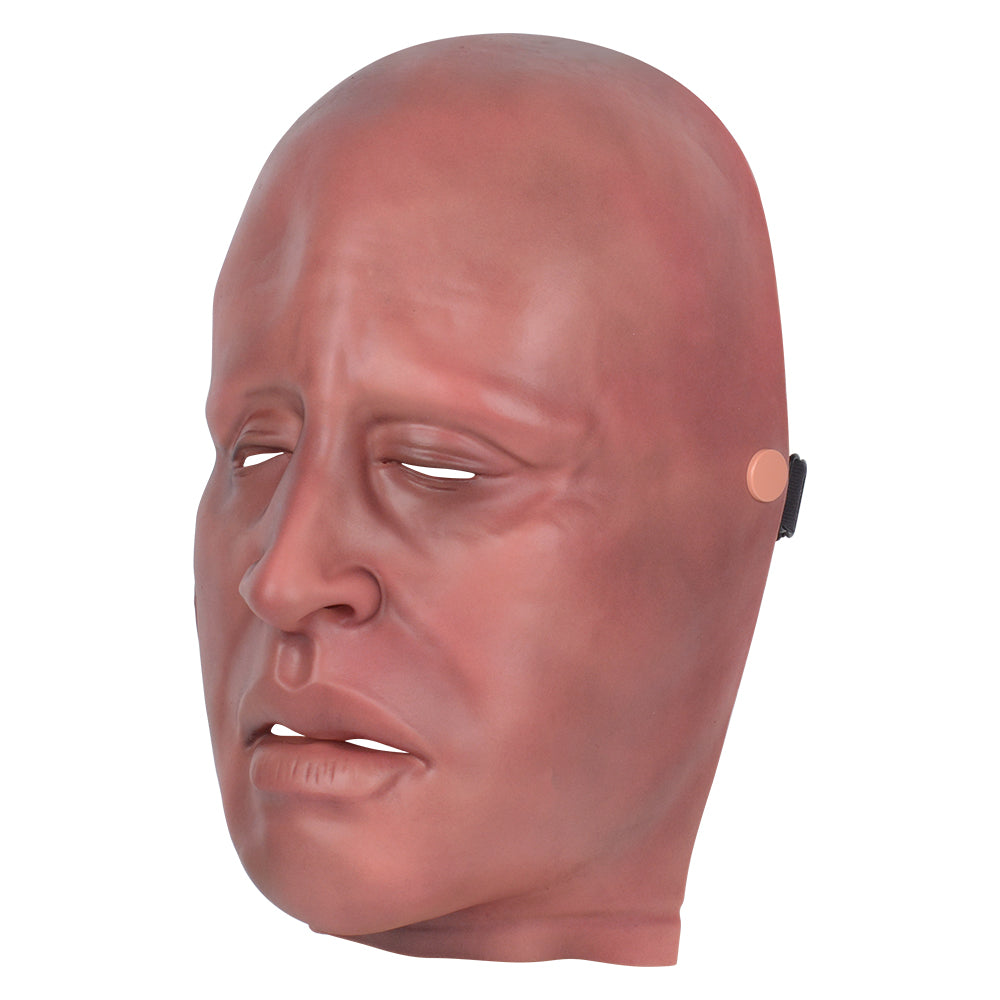 Mild Burn Face Moulage Showing Redness And Blisters