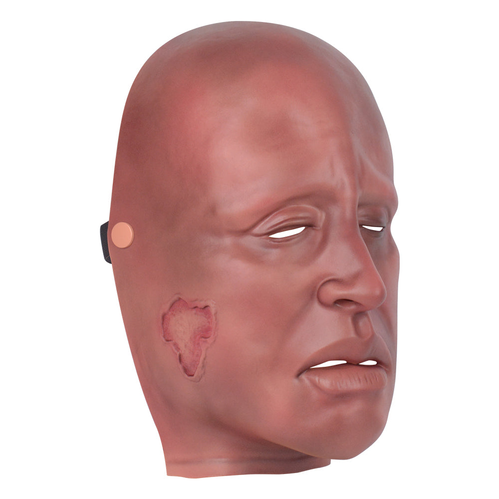 Mild Burn Face Moulage Used In Clinical Training