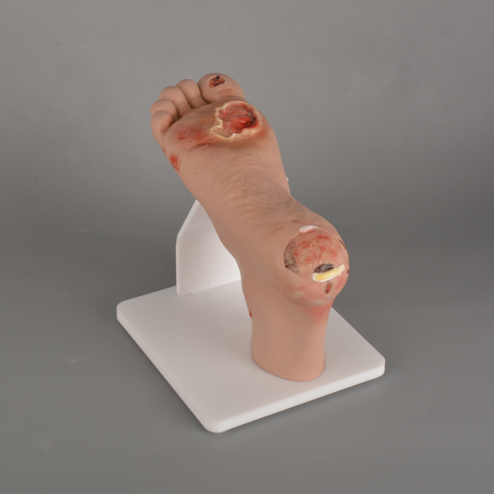 Mild Diabetic Foot Model (Full Foot)