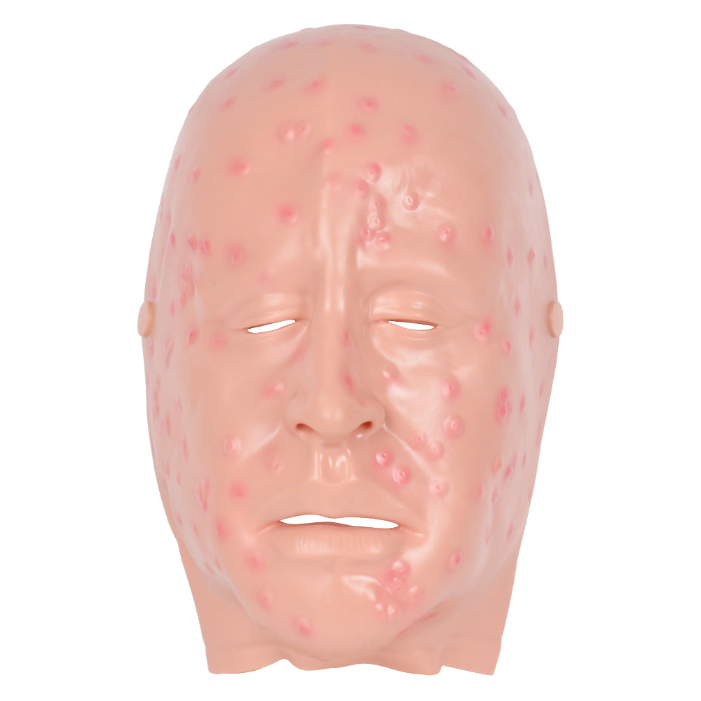 Mild Smallpox Face Moulage For Training