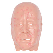 Mild Smallpox Face Moulage For Training