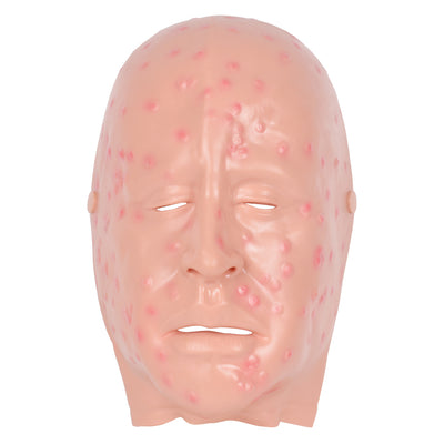 Mild Smallpox Face Moulage For Training