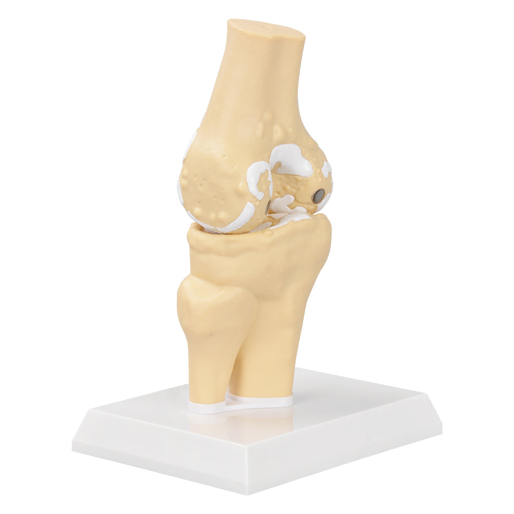 Movable Osteoarthritis Knee Model Demonstration