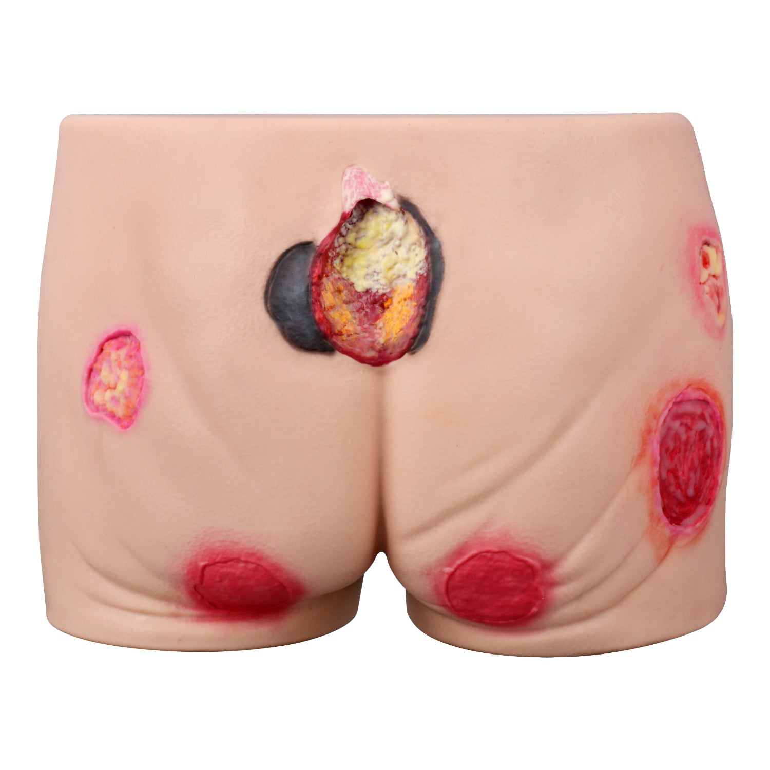 Multi-Stage Buttock Pressure Ulcer Training Model (Silicone)