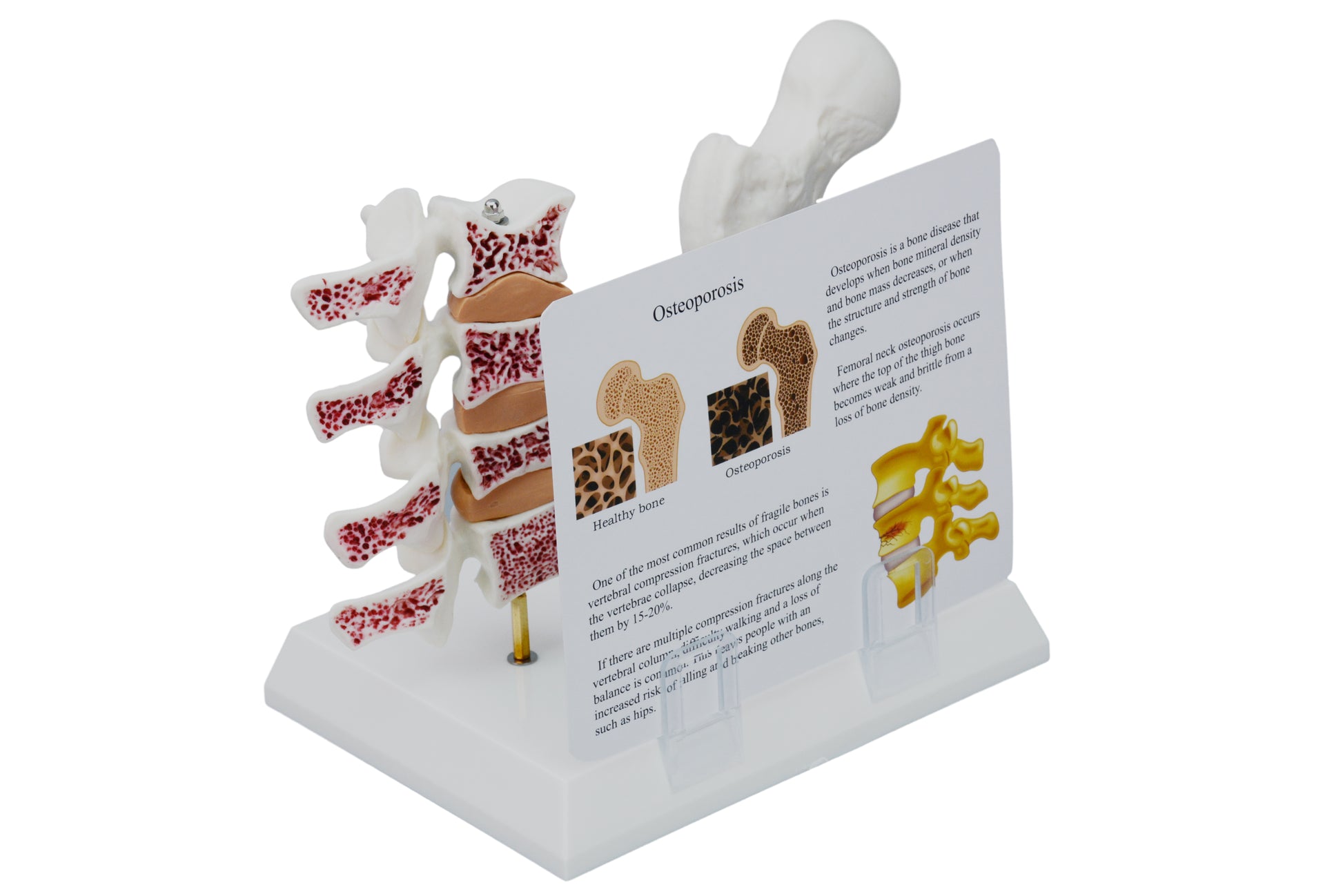 Osteoporosis Anatomy Model With Study Card