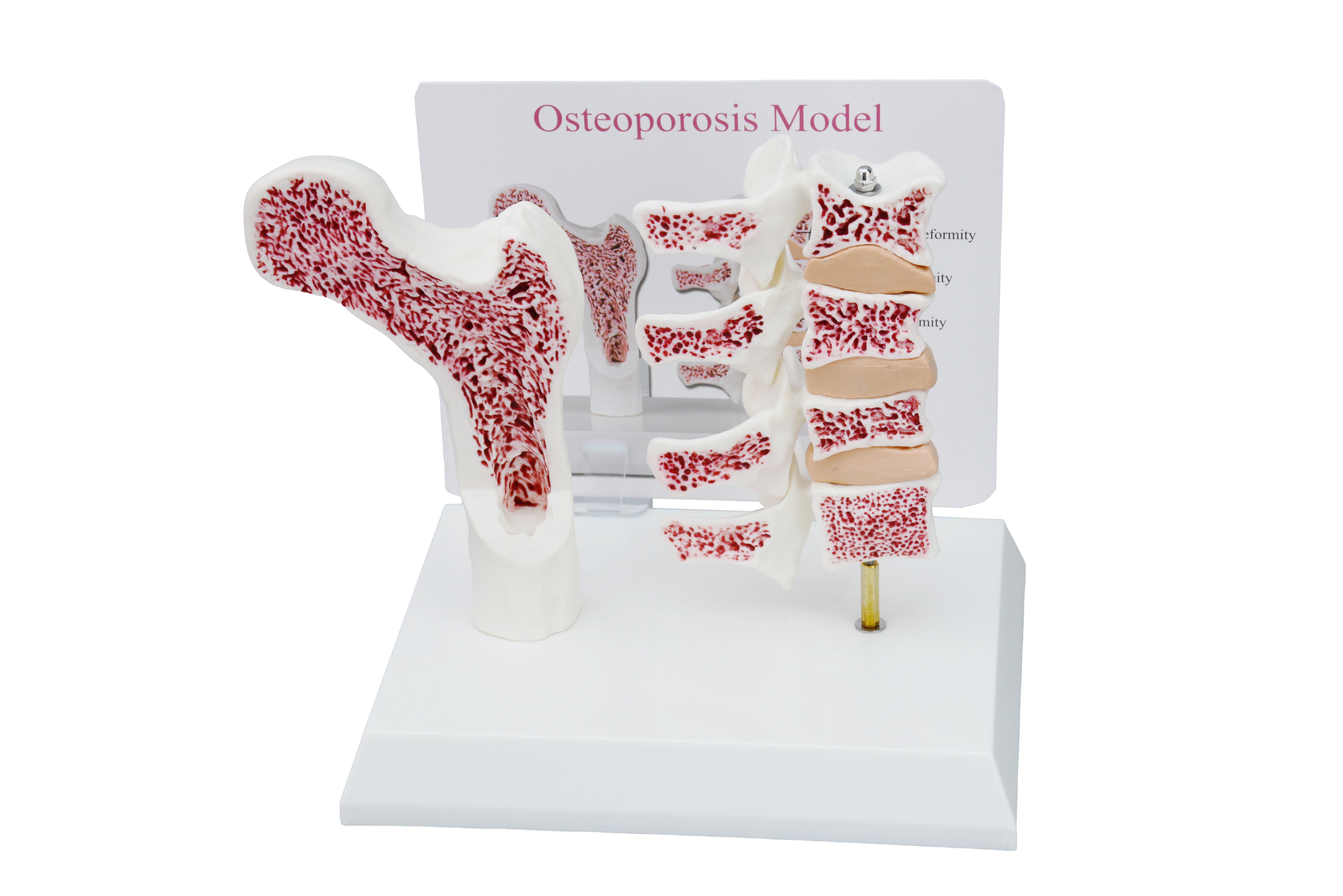 Osteoporosis Vertebrae And Femur Bone Model For Medical Teaching ...
