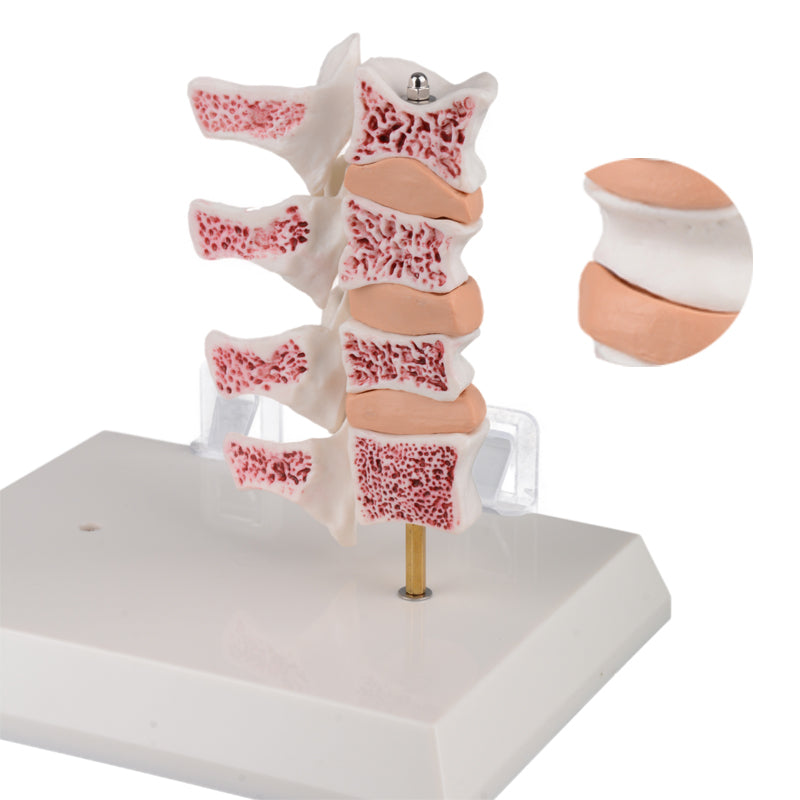 Osteoporosis Vertebrae Model