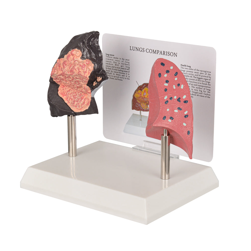 Pathological Lung Section Model