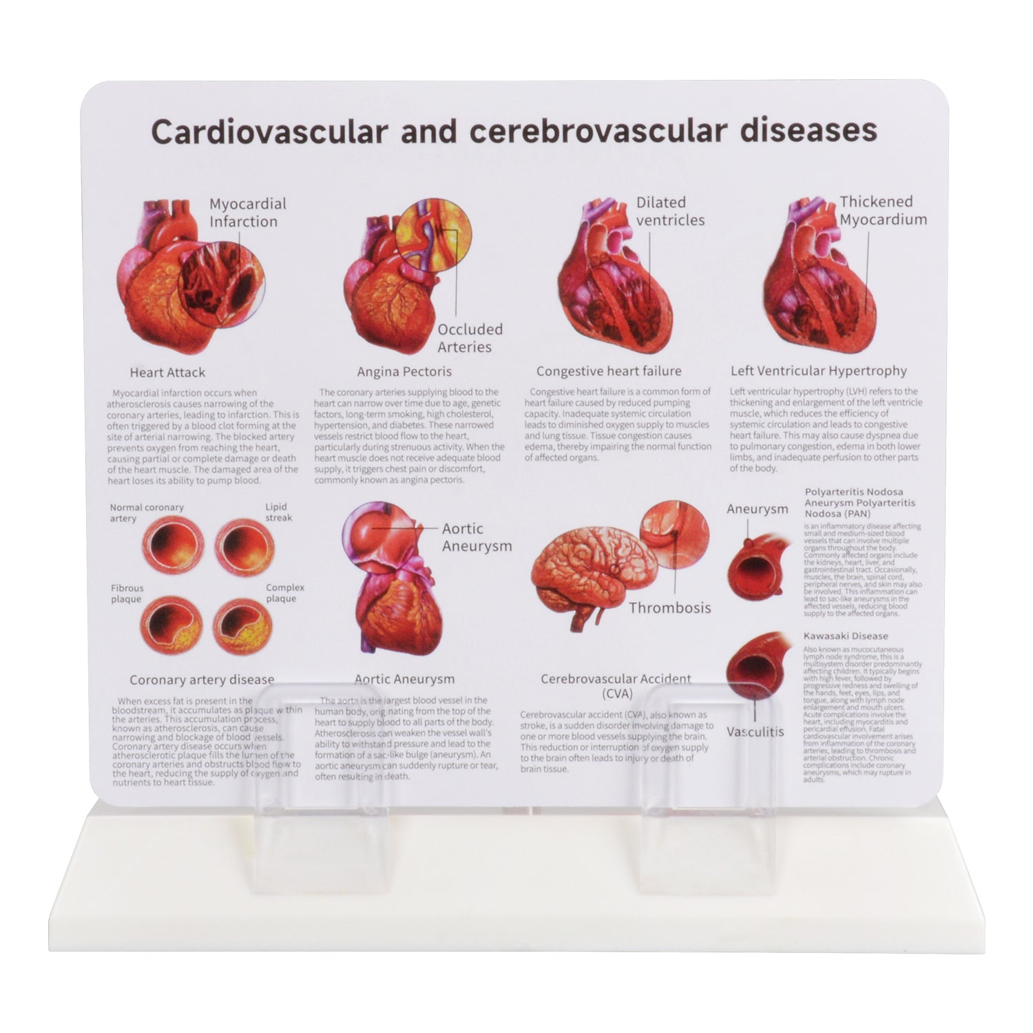 Pathology Learning Cards Display For Atherosclerosis Study