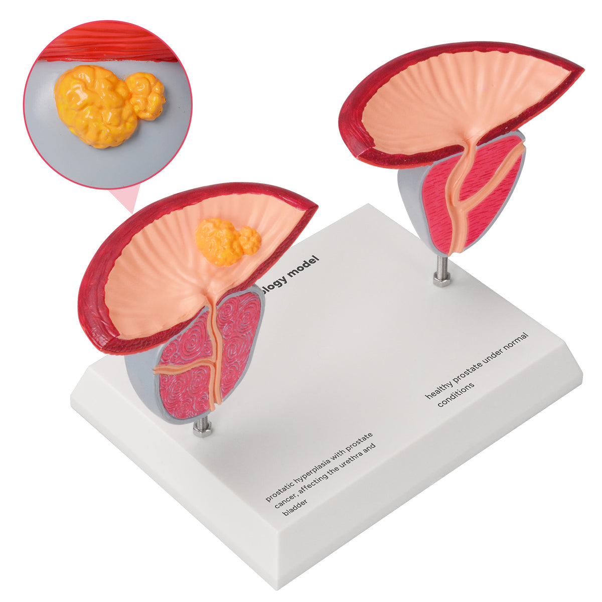Prostate Scale Modle Men's Health Education Models – Medarchitect