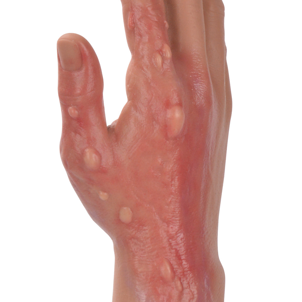 Realistic Silicone Burn Arm Model For Medical Training