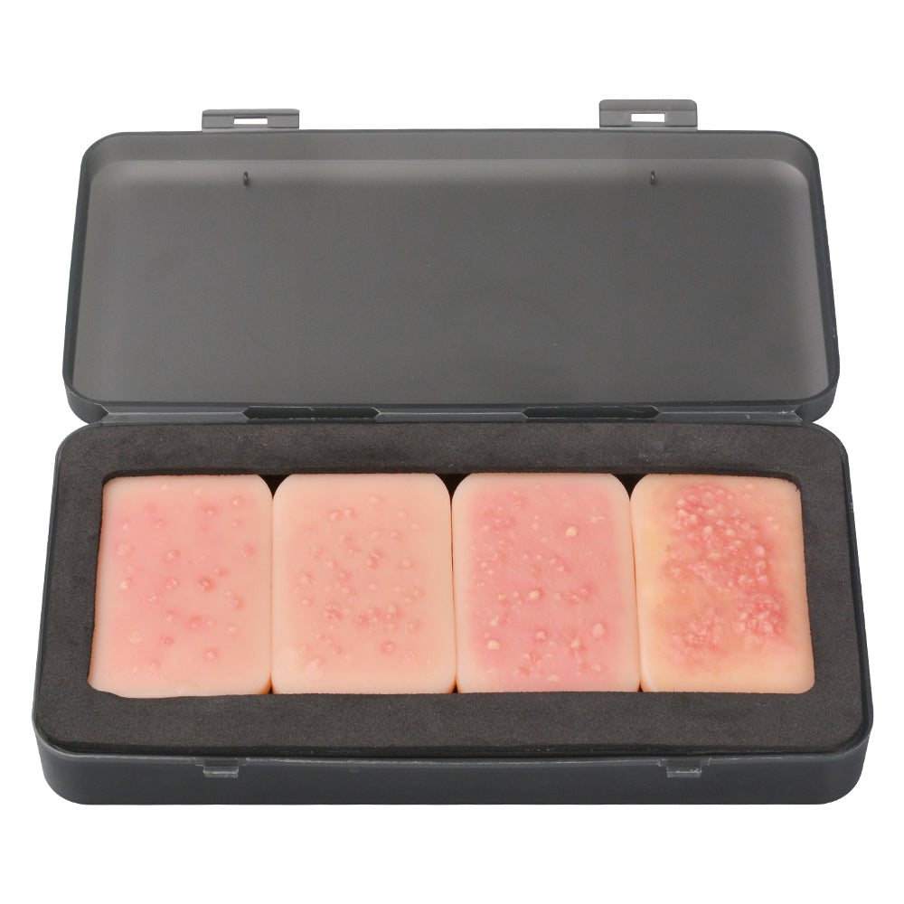 Realistic Stage 1-4 Facial Acne Model