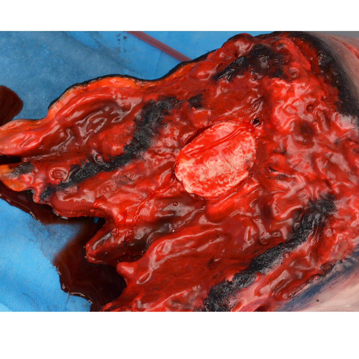 Severe Blast Thigh Amputation Training Model With Realistic Wound Detail