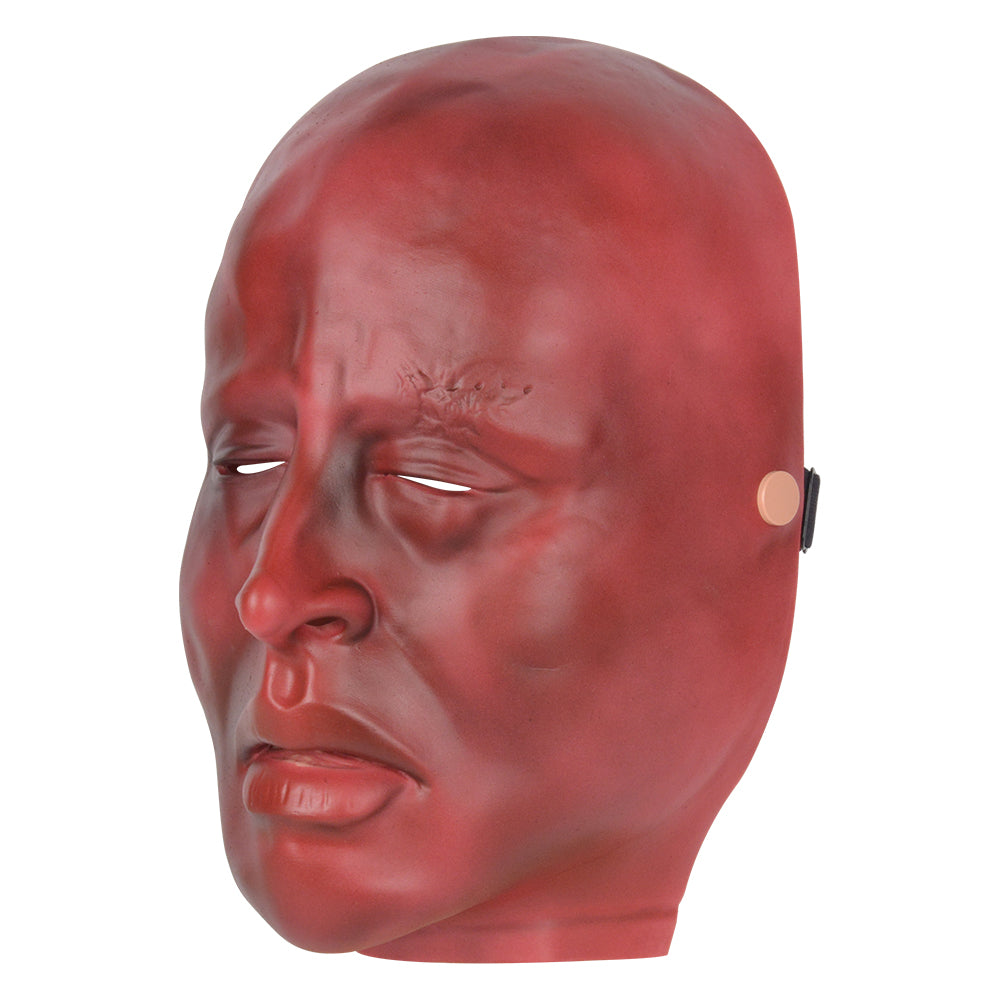 Severe Burn Face With Charred Skin