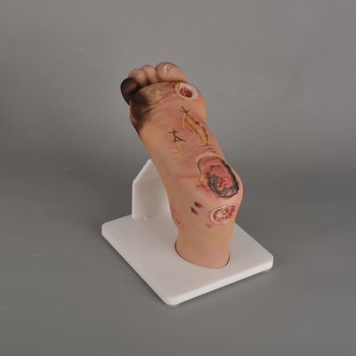 Severe Diabetic Foot Model